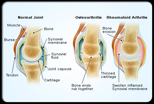 Bahaya Radang Sendi atau Rheumatoid Arthritis (RA) – D U N 